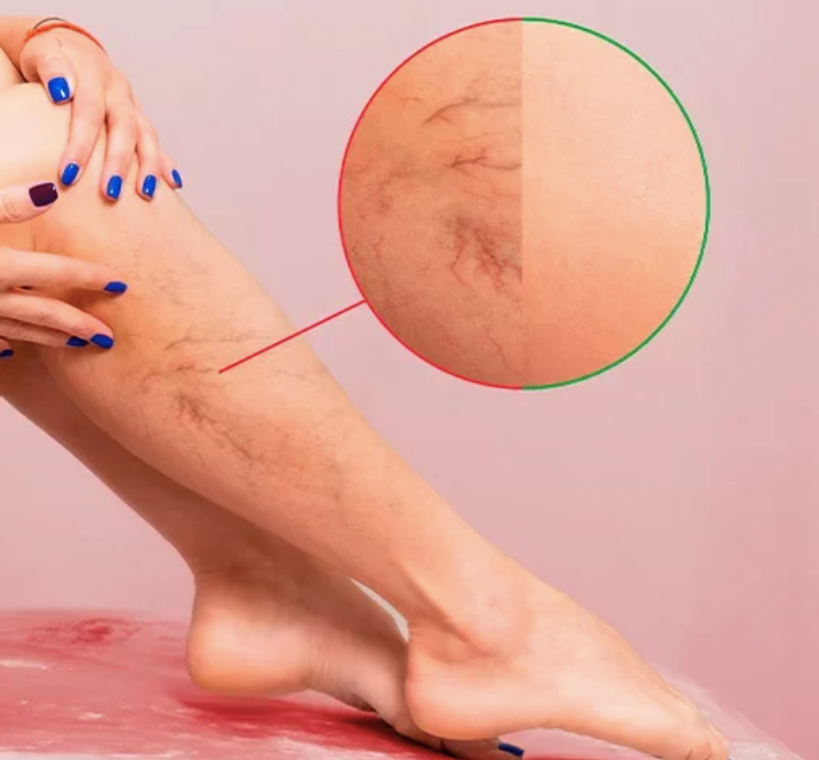 Varicose crema para varices
