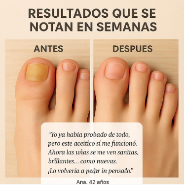 Vitaluñas - Uñas Sanas, Seguras y Sin Hongos