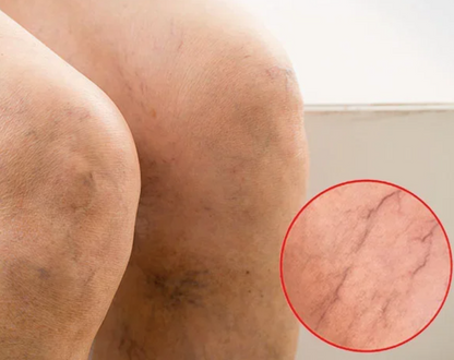 Varicose crema para varices