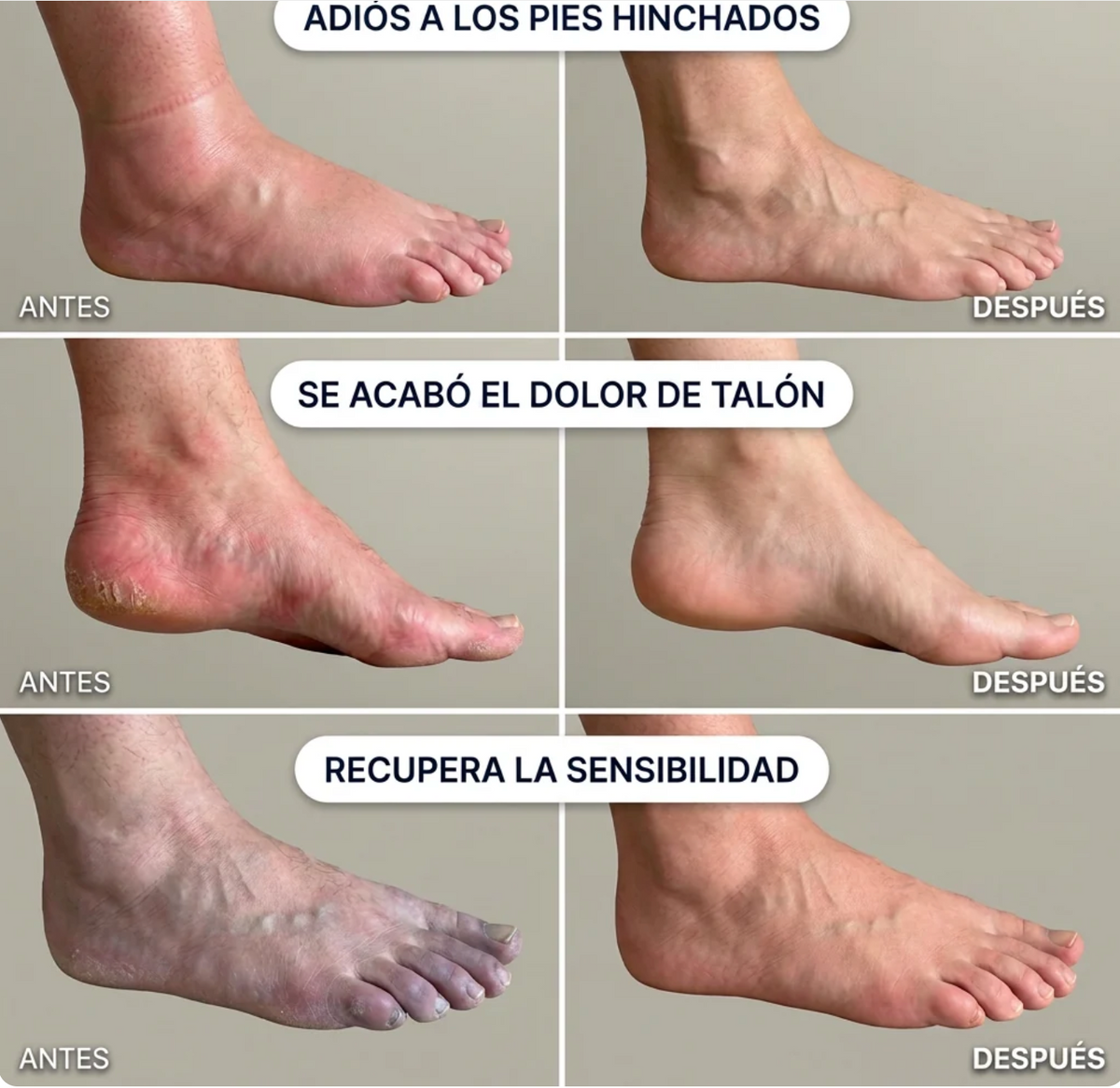 VenaFlex Masajeador 3 en 1 Elimina hinchazon, Neuropatía y fascitis en 15 minutos.